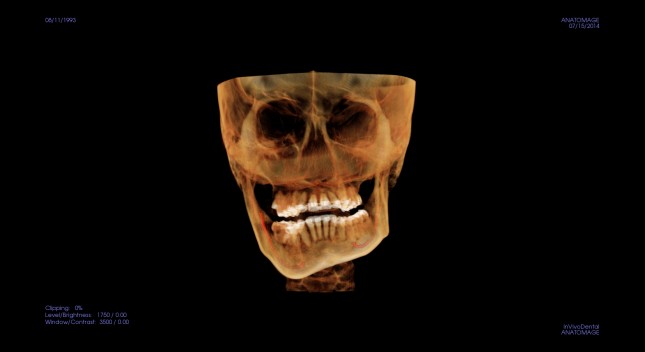 颌面部骨骼的三维重建 