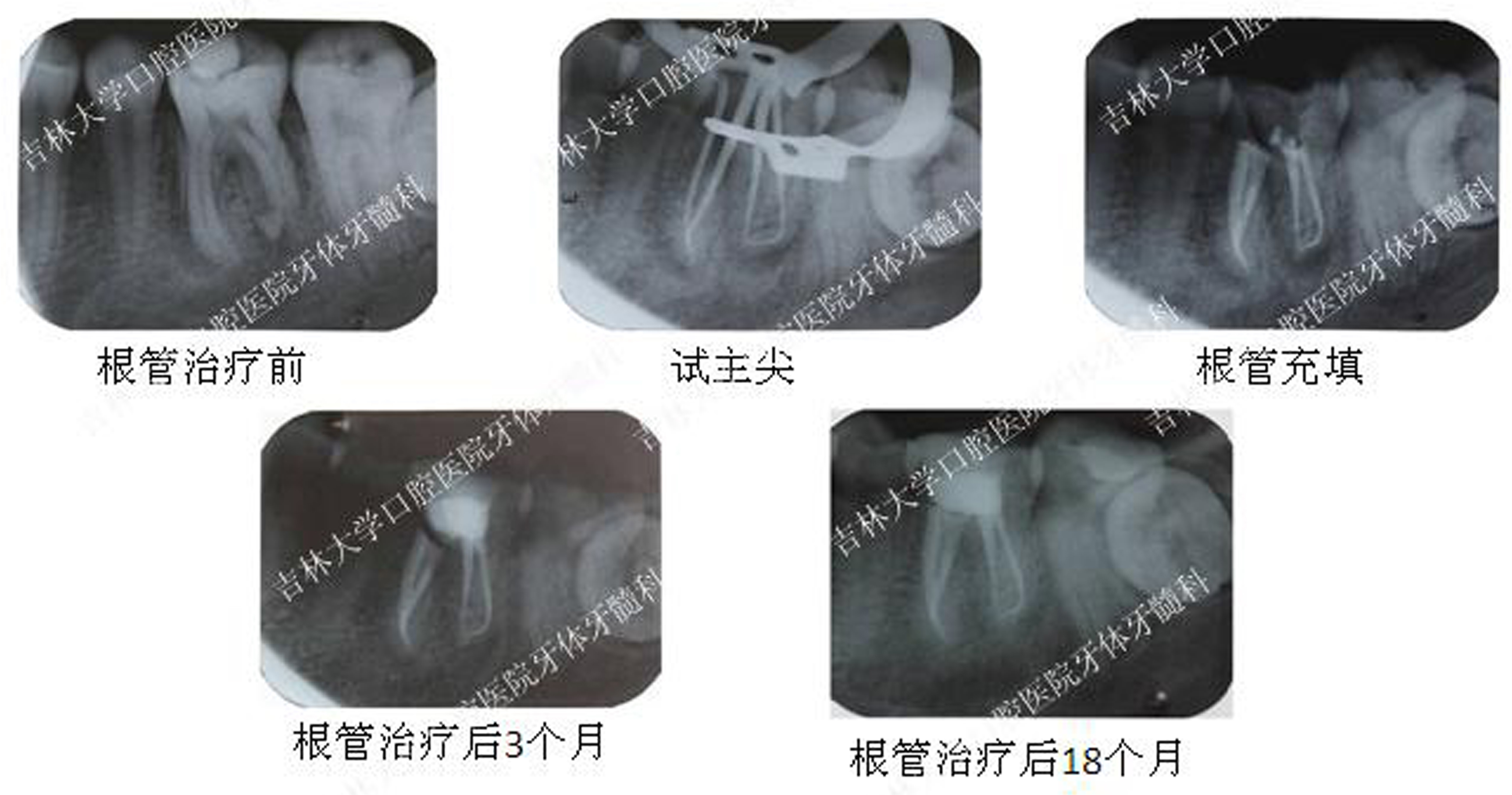 科室配備11臺根管顯微鏡,輔以10餘種鎳鈦根管擴大系統,超聲波根管治療